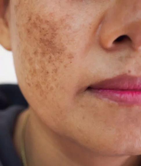 MELASMA / HIPERPIGMENTACIÓN